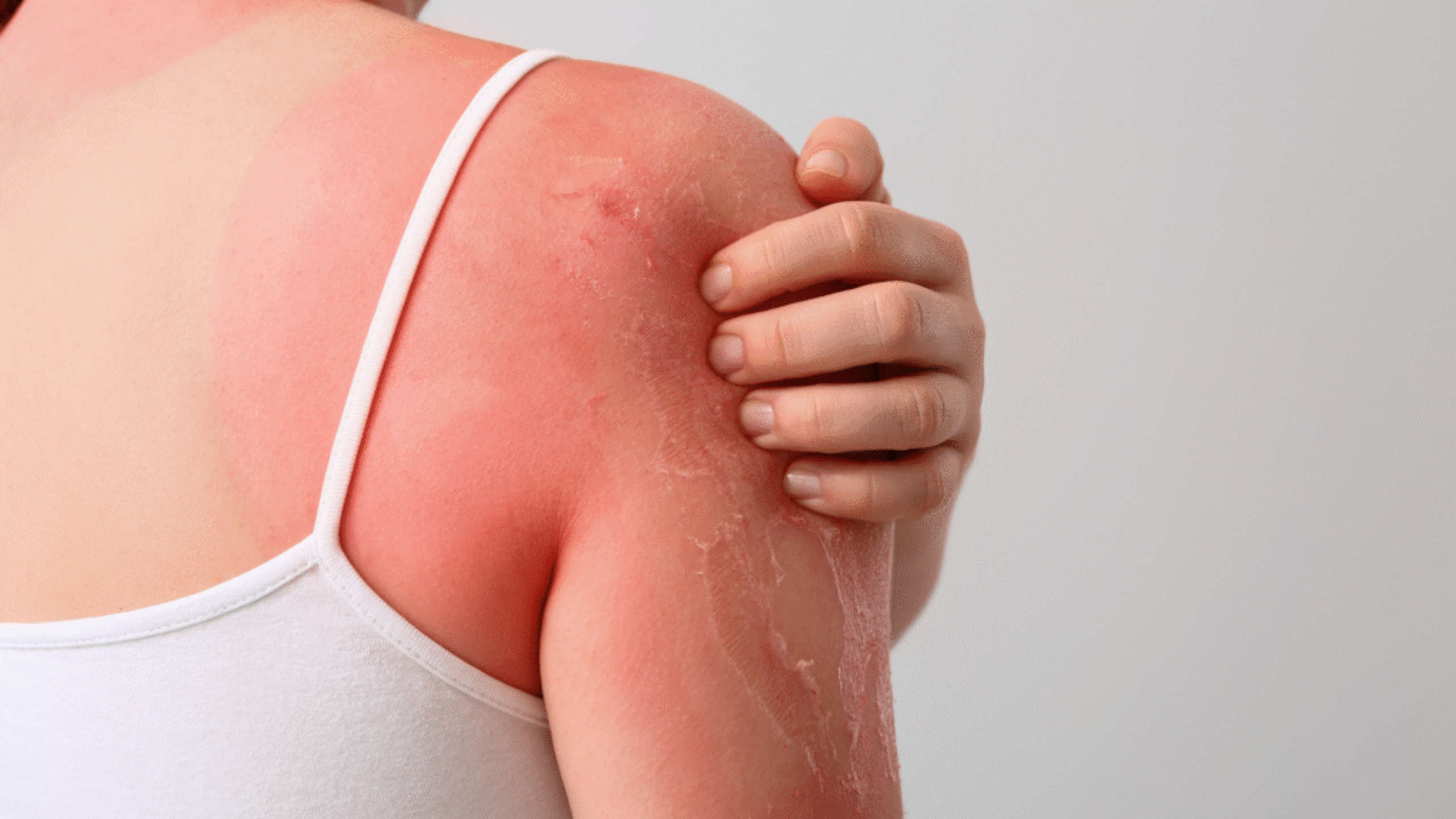 woman with severe sunburn